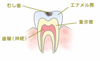 C1：エナメル質の虫歯