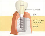 インプラント治療