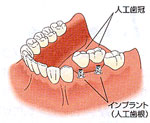 インプラント